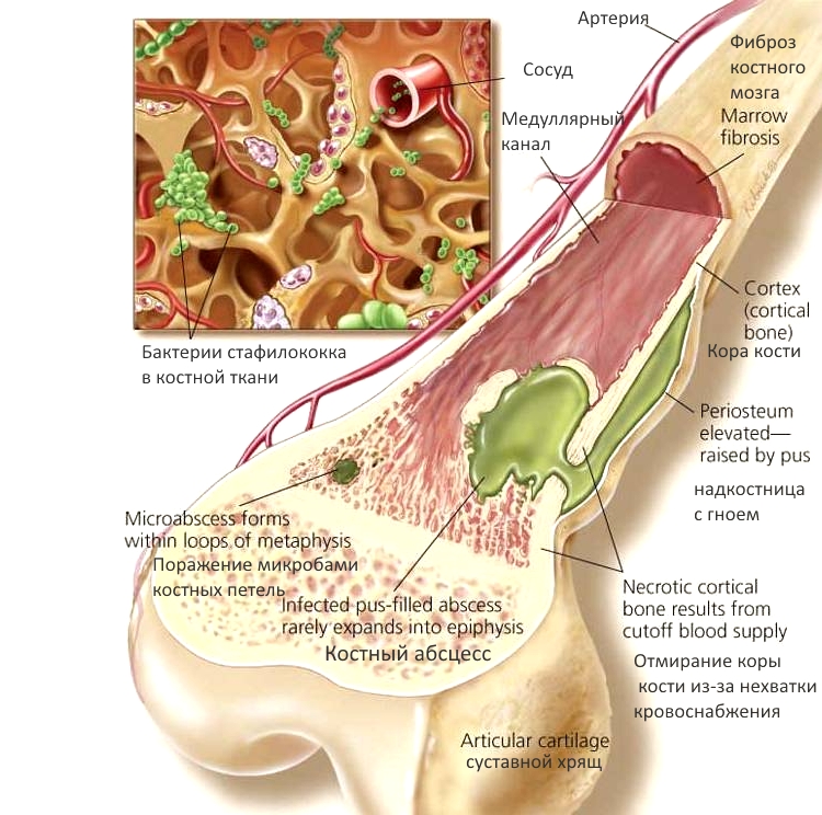Виды гематогенного остеомиелита и особенности лечения