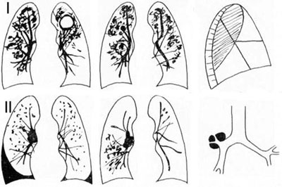 Особенности диссеминированного туберкулёза лёгких