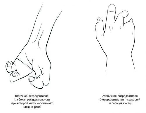 Причины синдактилии (сросшихся пальцев) и ее лечение