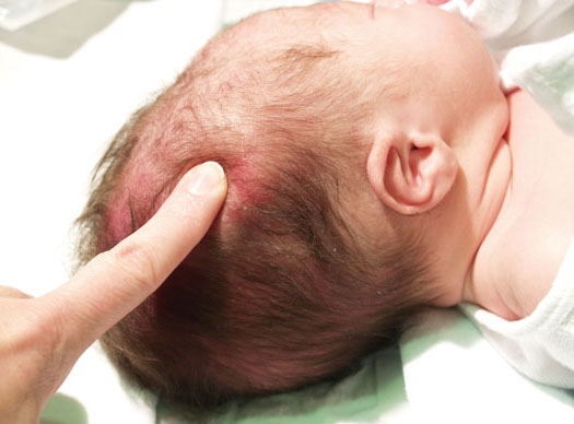 Как проявляется перелом черепа у грудного ребенка и чем лечить?