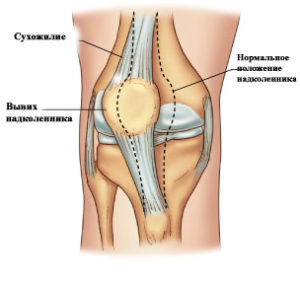 Причины болей под и над коленным суставом у подростка: методы лечения и профилактики