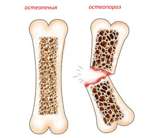 Чем отличается болезнь остеопороз от остеопении?