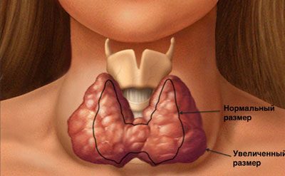 Причины и лечение кашля при увеличенной щитовидке