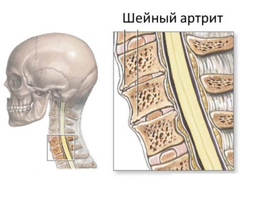 Почему возникает боль в области шеи с левой стороны?