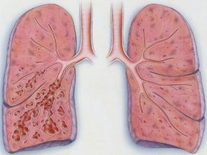Образование в лёгких бронхоэктазов: особенности патологии, диагностика