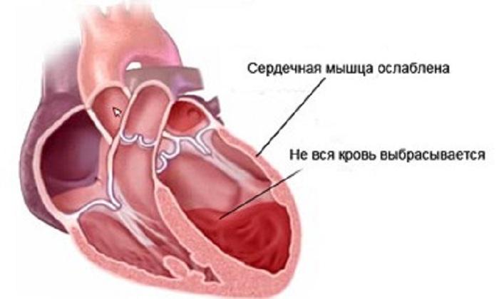 Сердечный кашель
