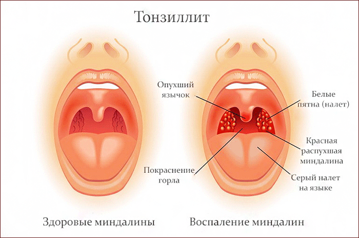 Как выбрать проверенное средство от кашля и боли в горле