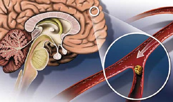 Склероз сосудов головного мозга: симптоматика, причины и методы лечения