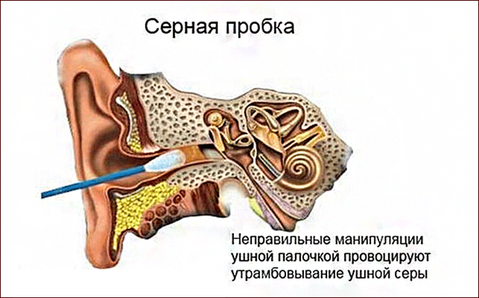 Причины и лечение шишки в ухе